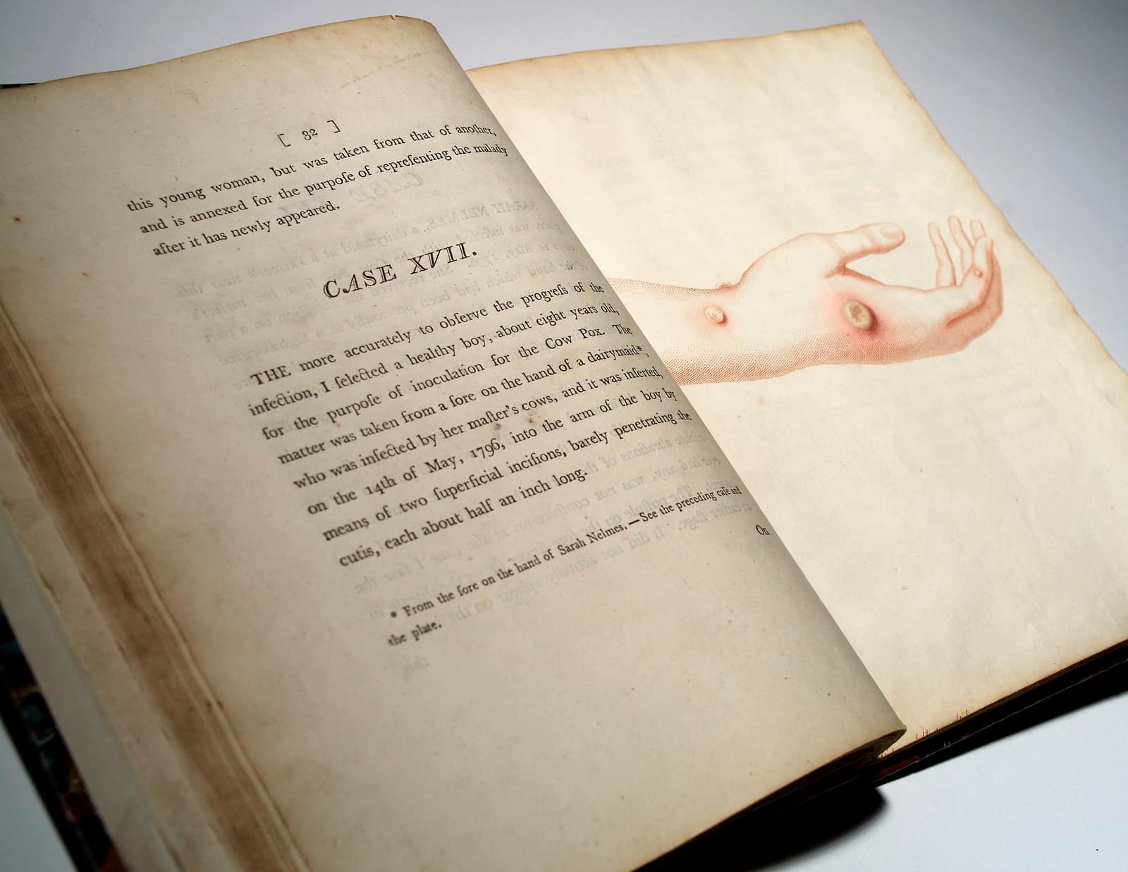 Un livre ancien est ouvert sur une surface blanche. La page de gauche, jaunie, porte le titre Case XVII et un paragraphe où l'auteur dit avoir choisi un garçon en bonne santé, âgé d'environ huit ans, pour l'inoculer avec la matière d'une pustule de vaccine prélevée sur la main d'une vachère, le 14 mai 1796, par deux incisions superficielles au bras. La page de droite porte une gravure coloriée à la main représentant un avant-bras et une main ouverte, d'un rose pâle, avec deux pustules rondes et saillantes cerclées de rouge, l'une sur le dos du poignet, l'autre près de la base du pouce.